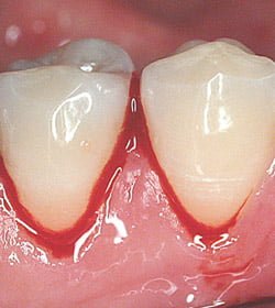 gum disease perio