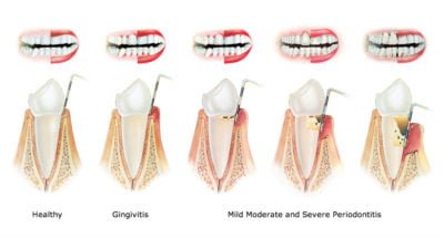 periodontitis