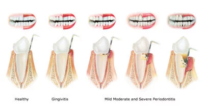 periodontitis