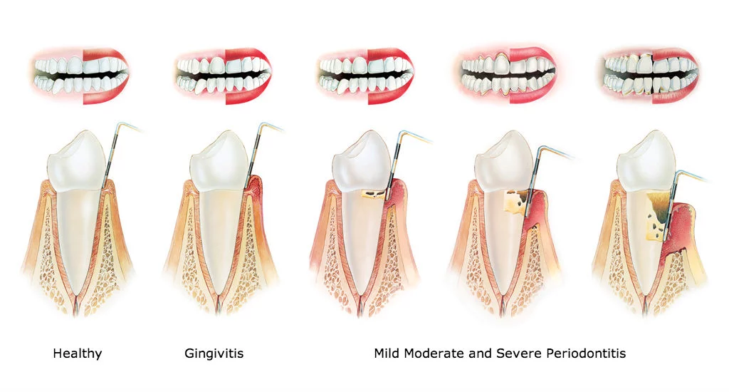 periodontitis