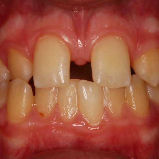 invisalign before