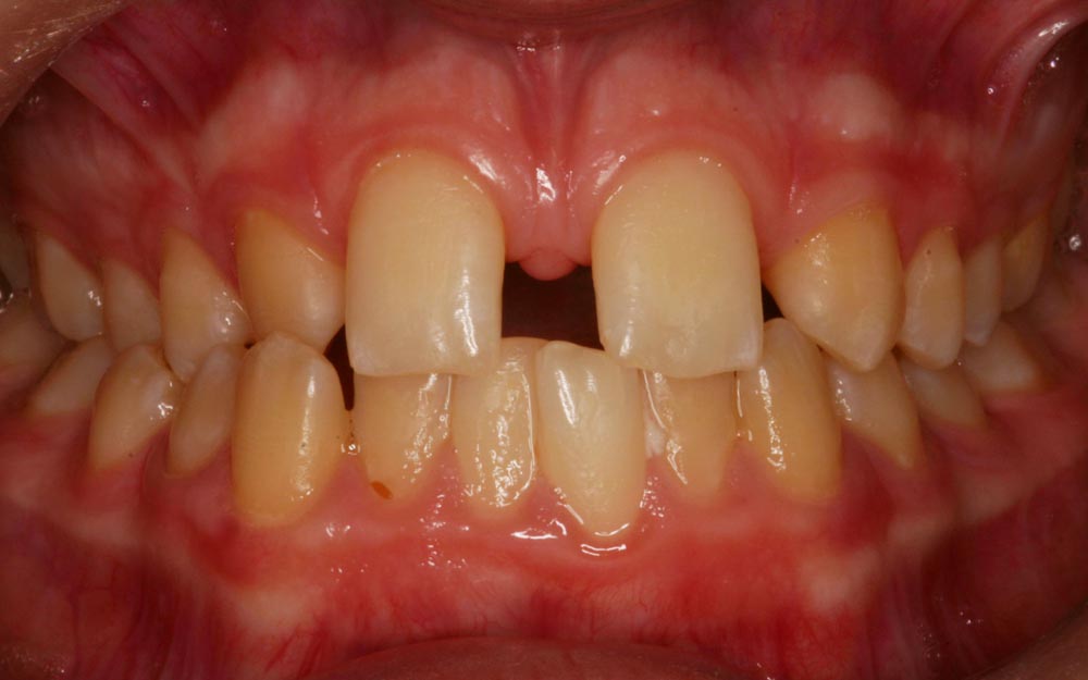 invisalign before