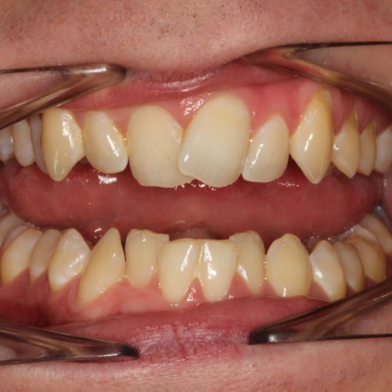 invisalign results