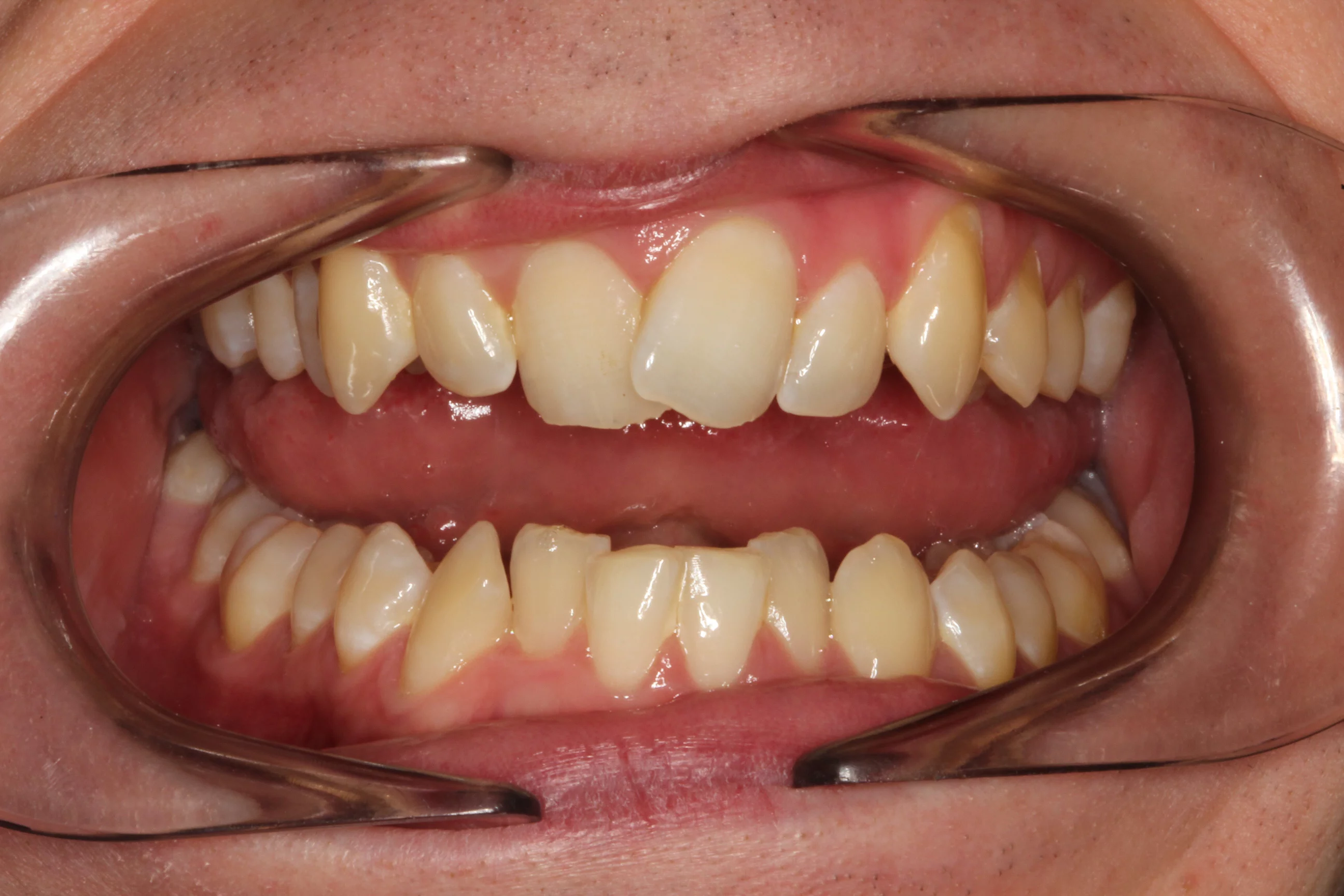 invisalign results