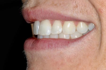 Left View of your Smile, with your teeth fully closed