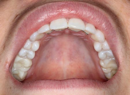 Mouth open bottom teeth