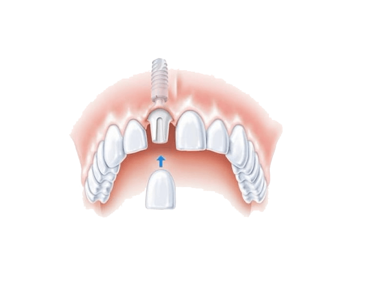 implant crown