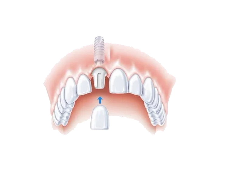 implant crown implant crown