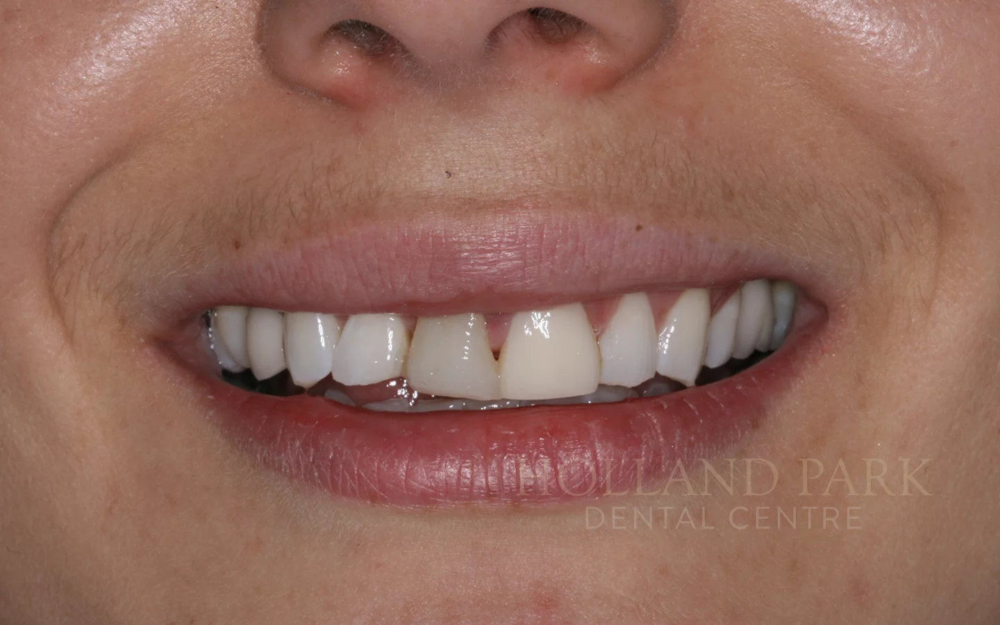 aesthetic restorations