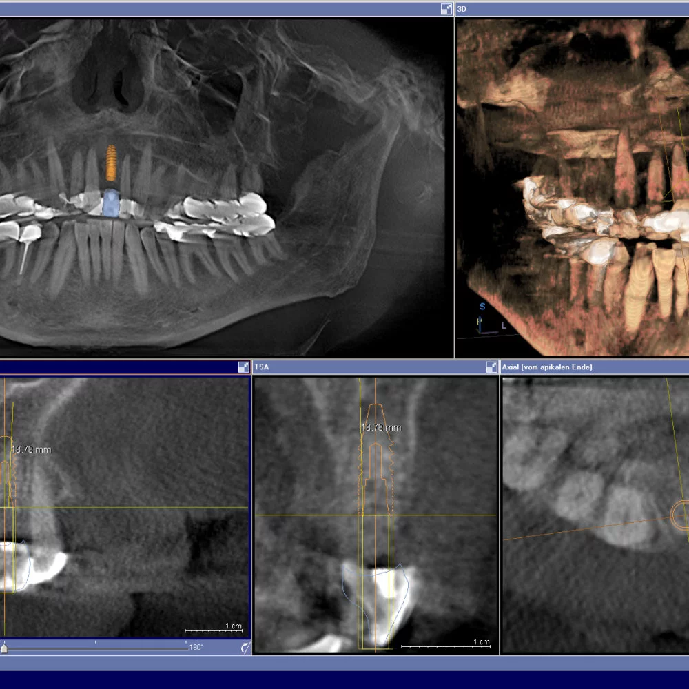 CAD images Image guided implant
