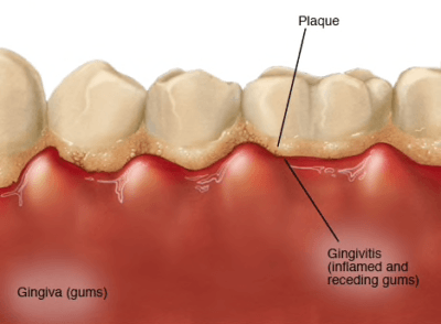 what is gingivitis?