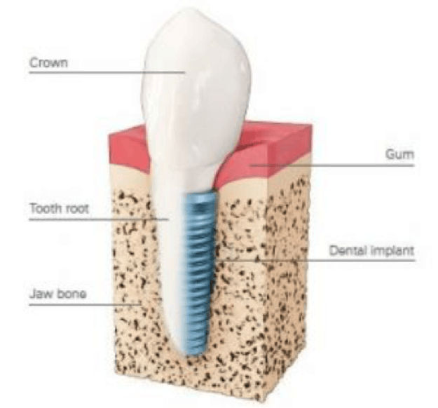 how do implants work