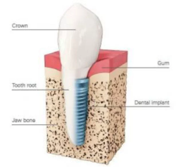 implant how do implants work