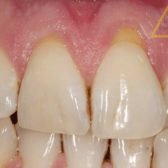 gum recession treatment 2