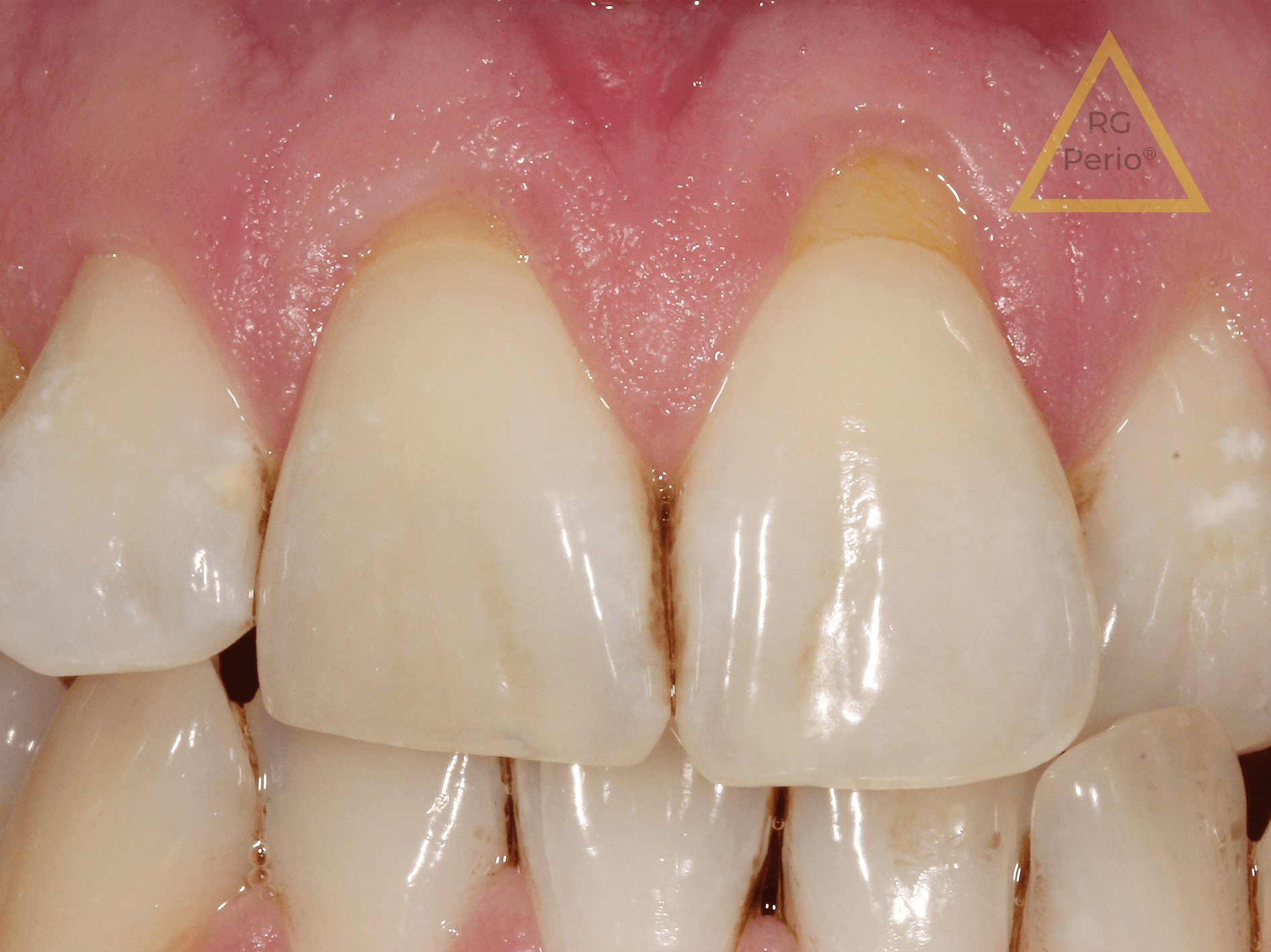 Gum Recession Surgery Before After Holland Park Dental