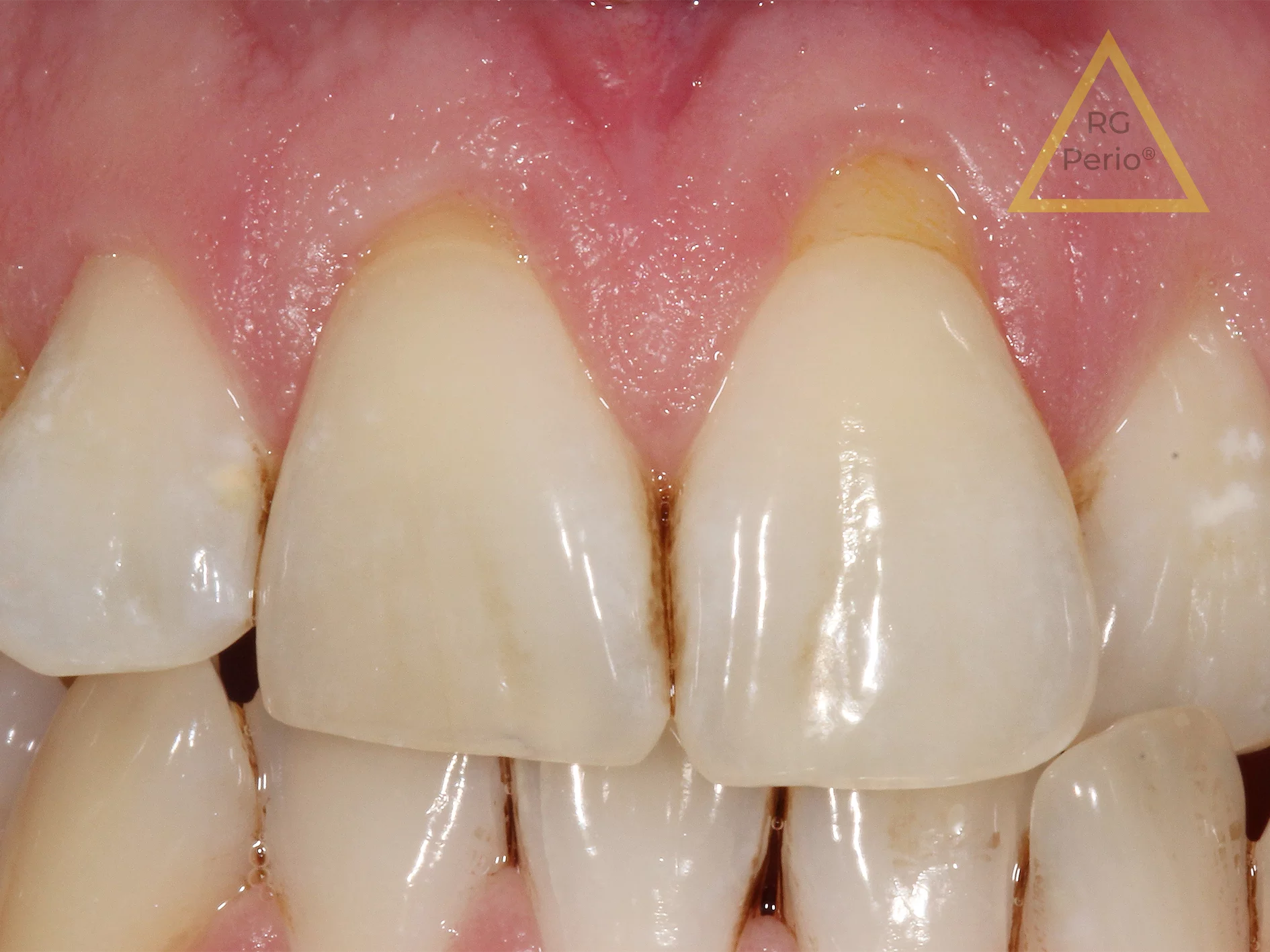 gum recession treatment 2