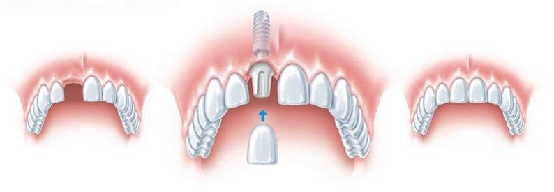 single tooth dental implant