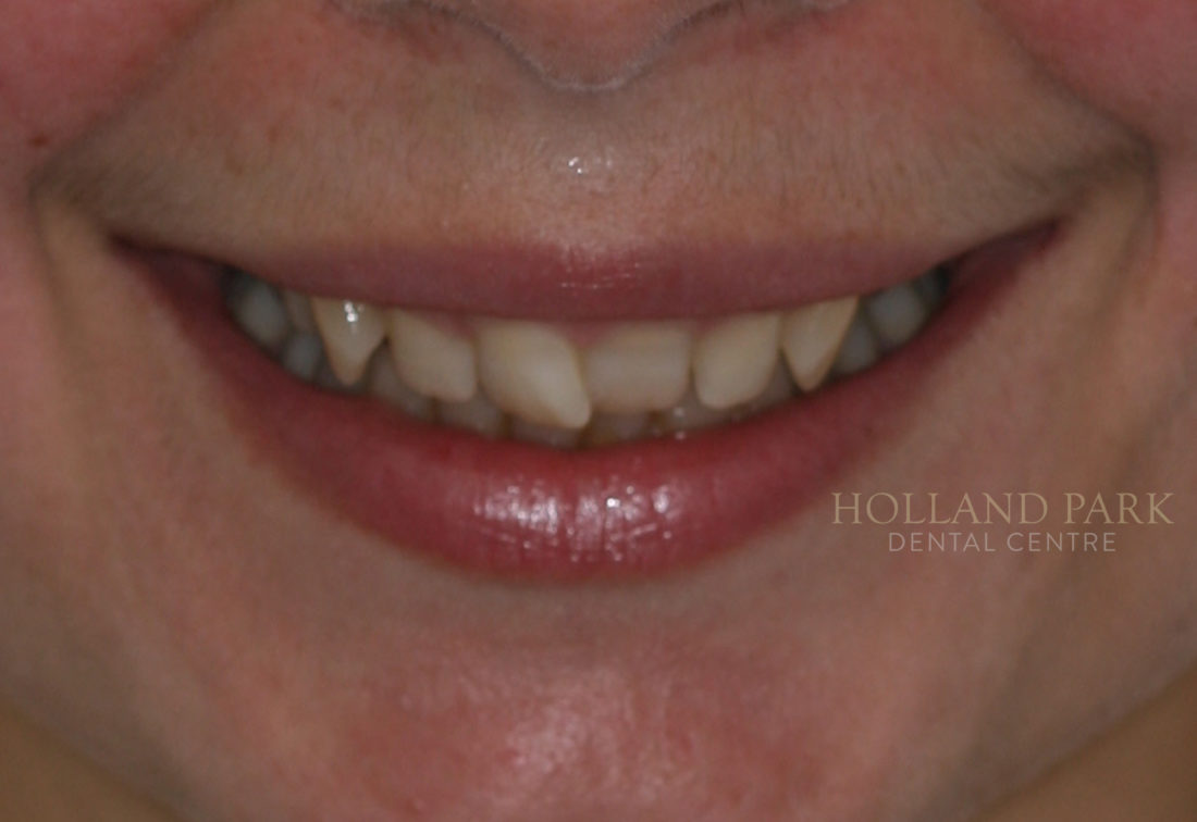 orthodontic results