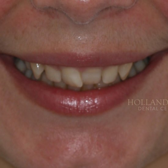 orthodontic results