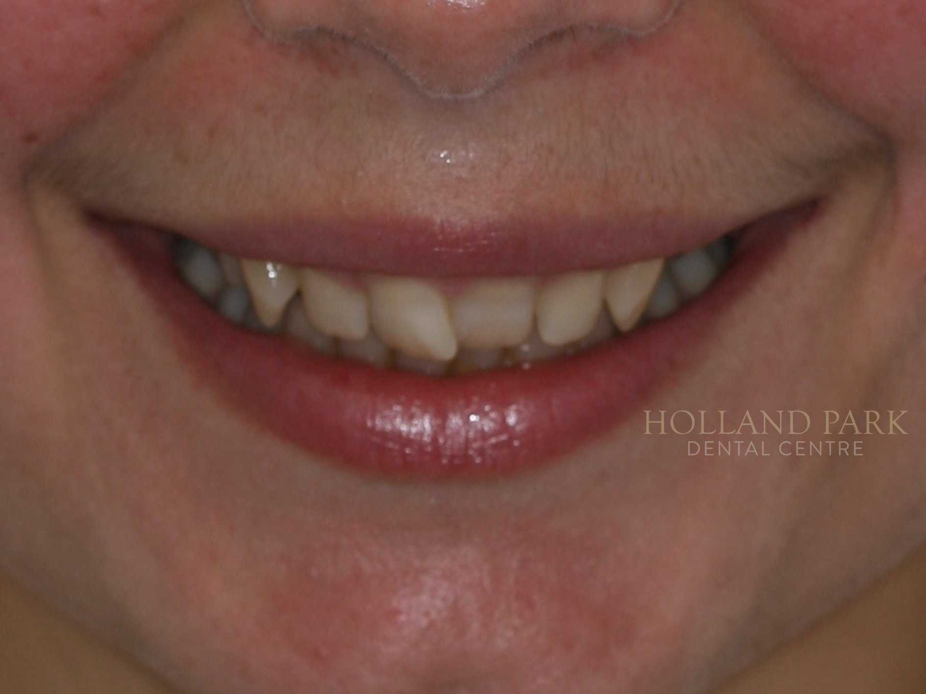 orthodontic results
