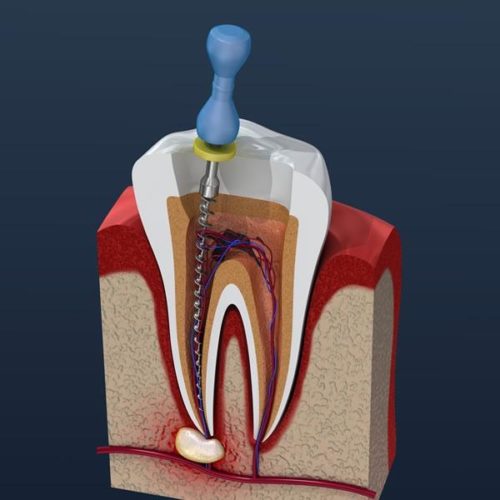 root canal