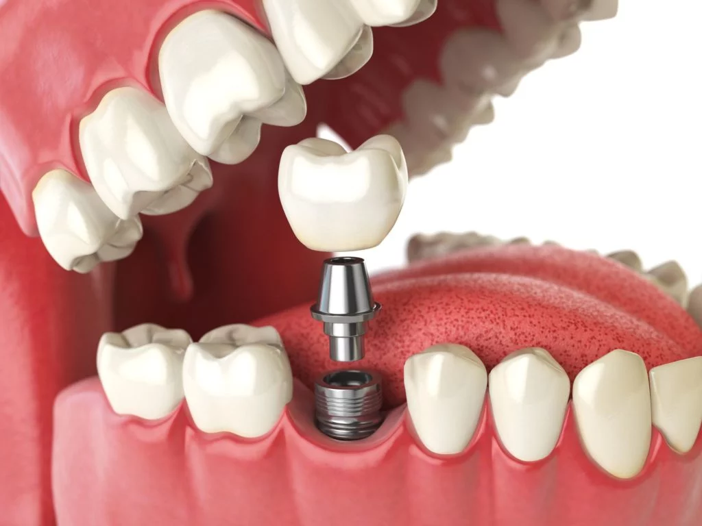 dental implant dental implant