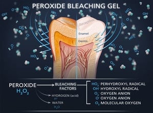Teeth Whitening How Does It Work Holland Park Dental