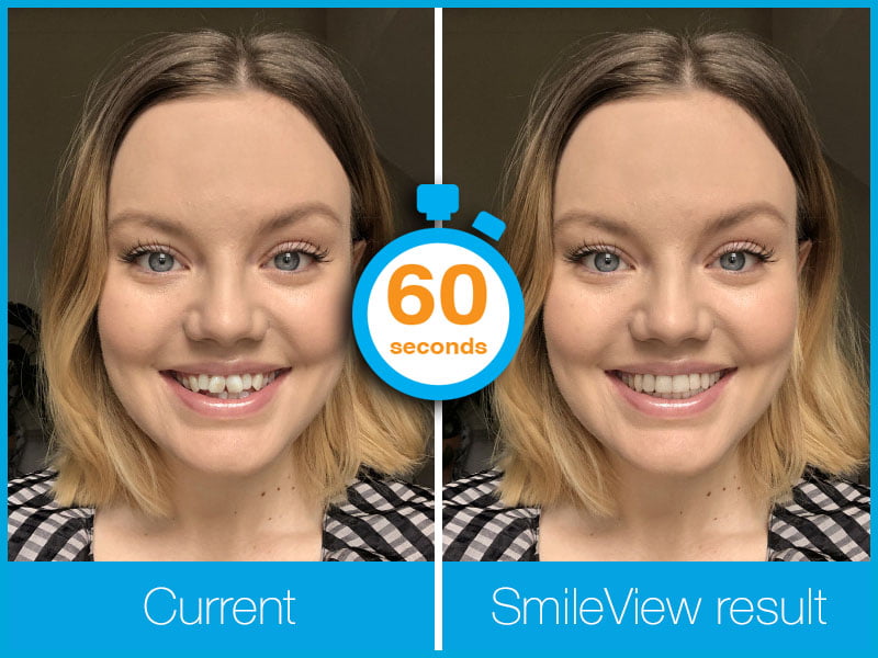 Invisalign+Smileview+in+60+seconds