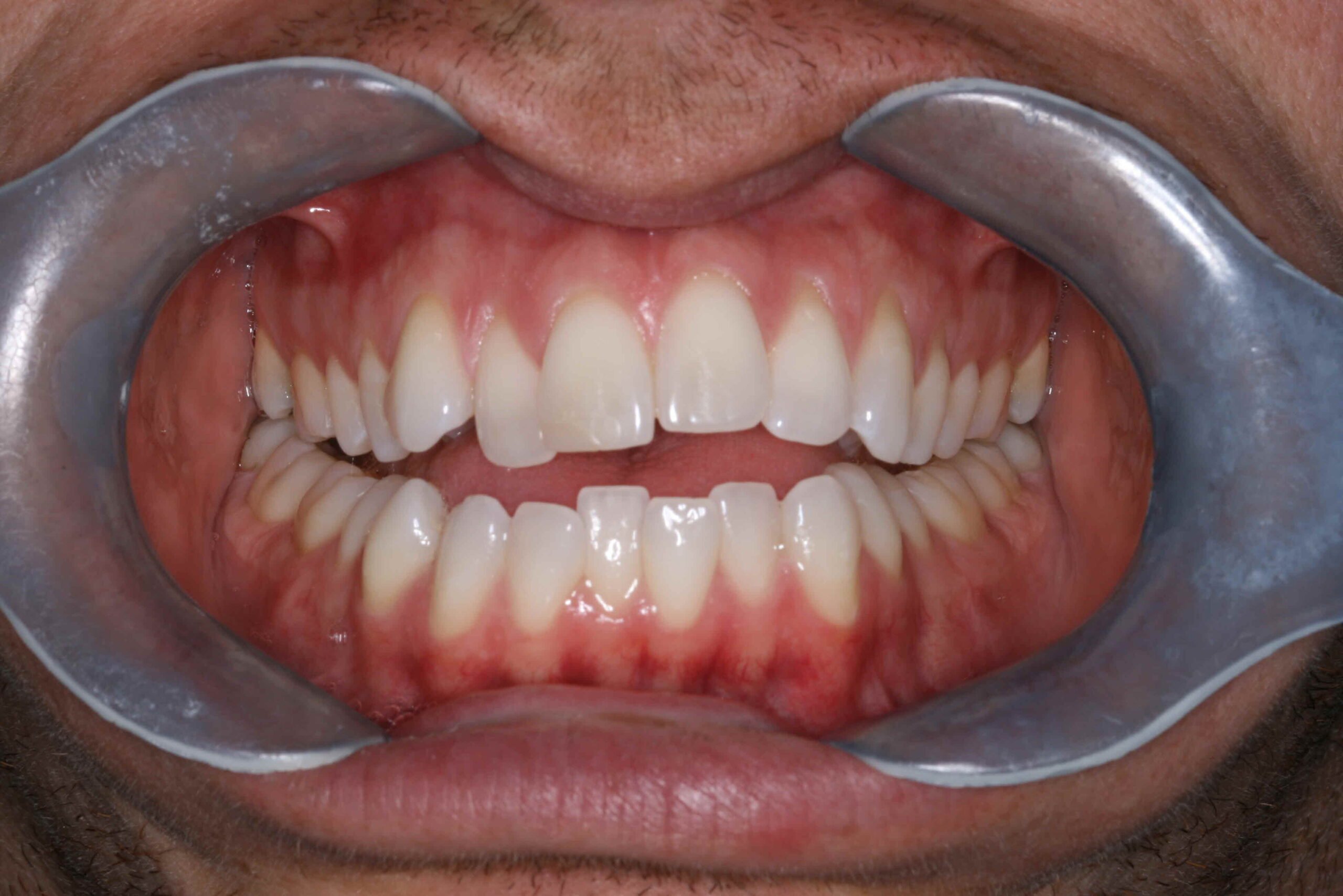 Invisalign Smile Transformation