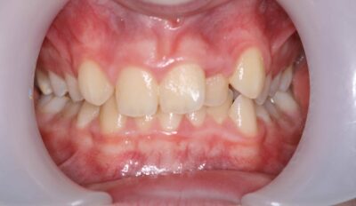 Early Ortho before pic 1 Early orthodontic assessment