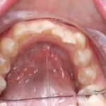 early orthodontic assessment