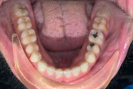 Mouth open bottom teeth
