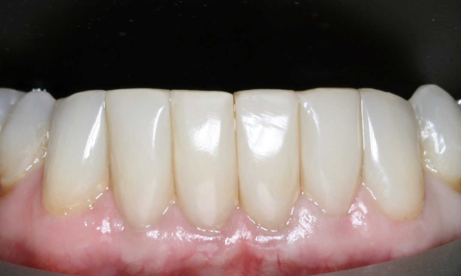 Black Triangle Teeth Treatment (Bioclear) in London – Holland Park Dental