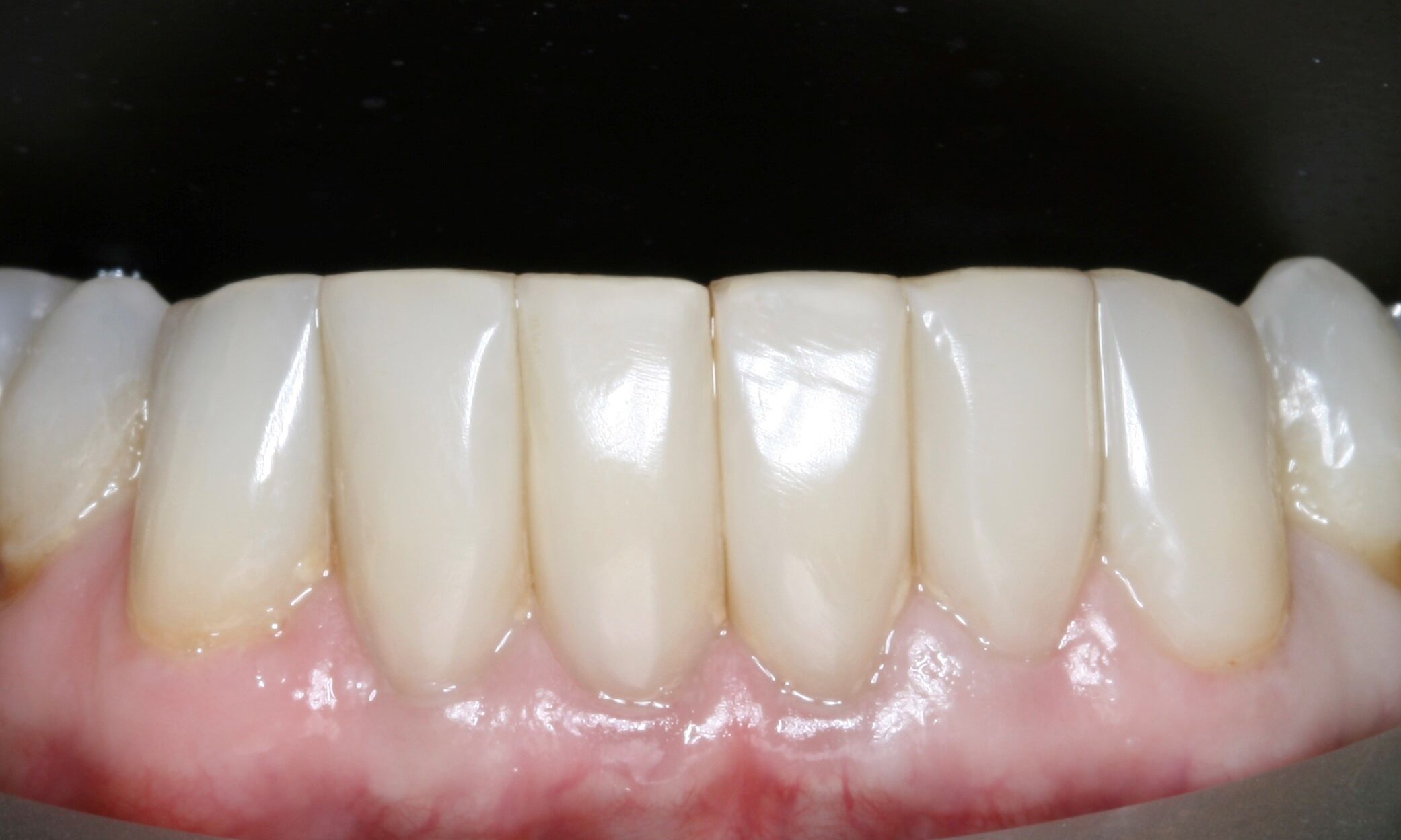 Image showing teeth after black triangle treatment