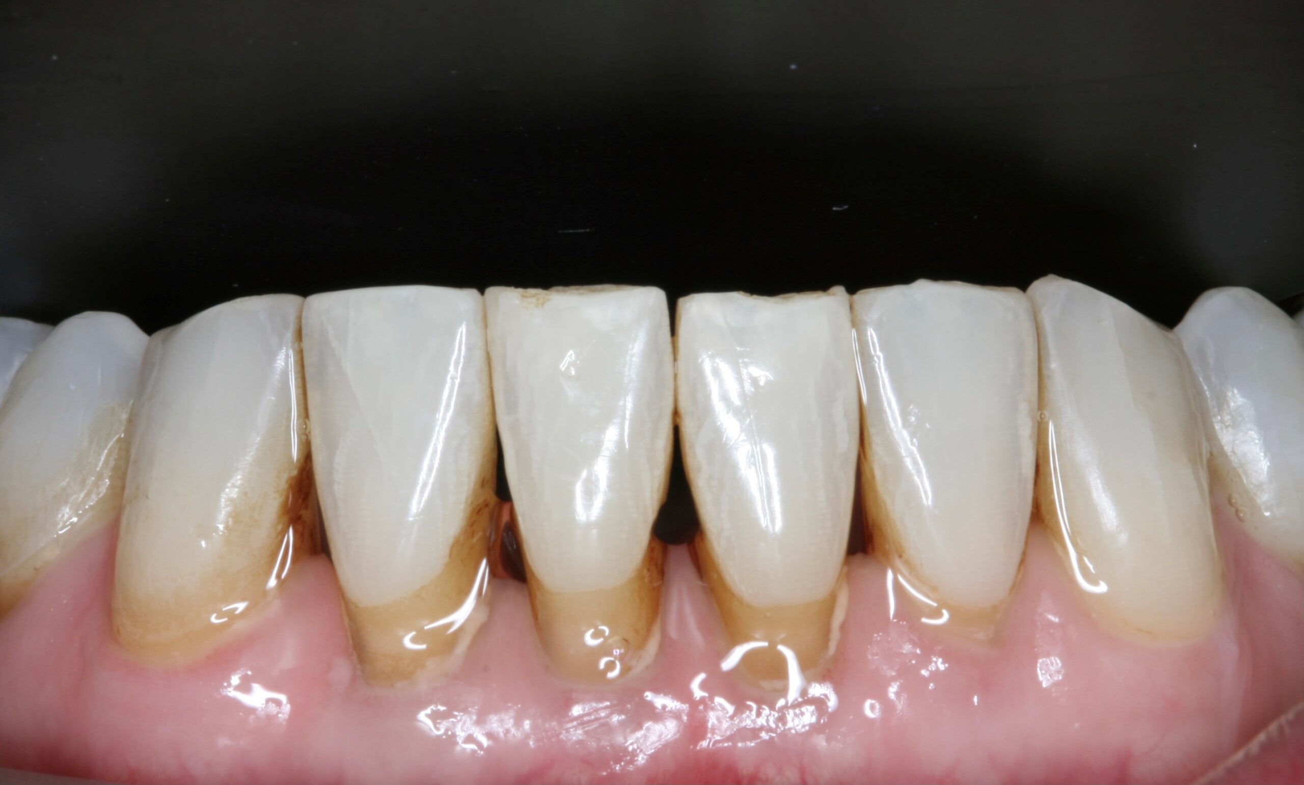 Image showing teeth before black triangle treatment
