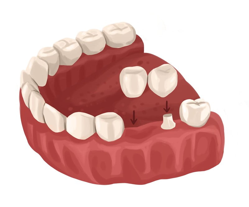 Illustration showing cantilever dental bridge
