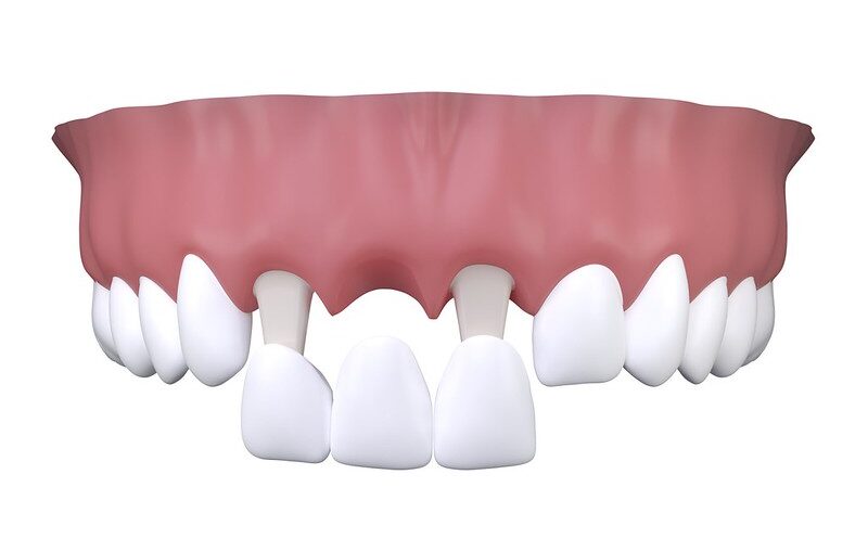 Illustration showing traditional dental bridge