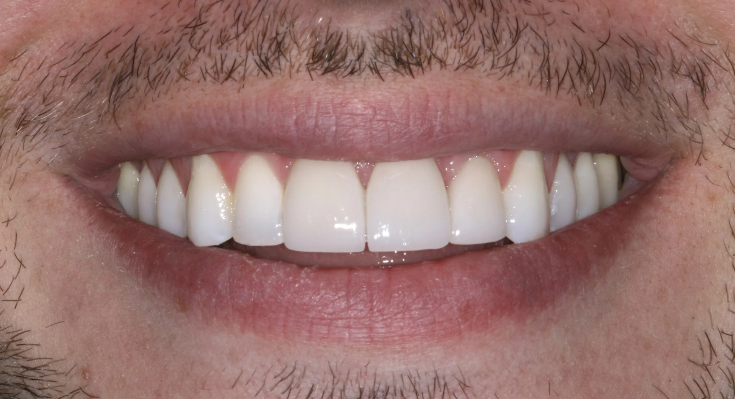 Image showing teeth before dental veneers