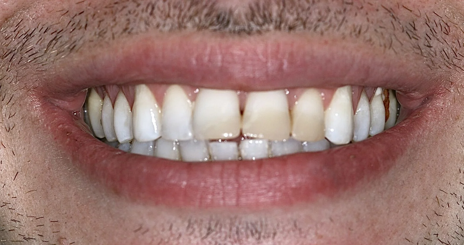 Image showing teeth before dental veneers