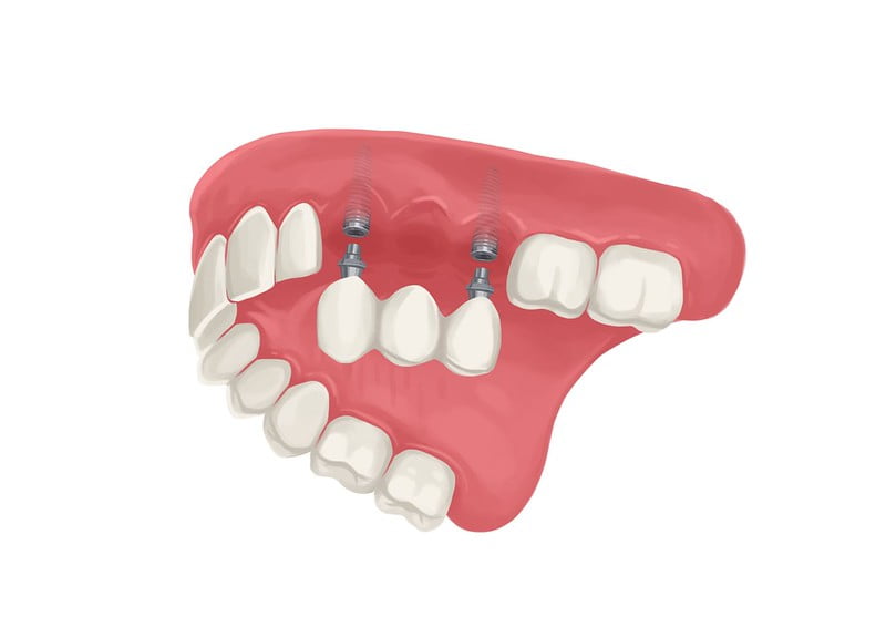 Illustration showing implant-supported dental bridge