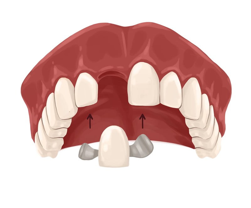 Illustration showing maryland dental bridge