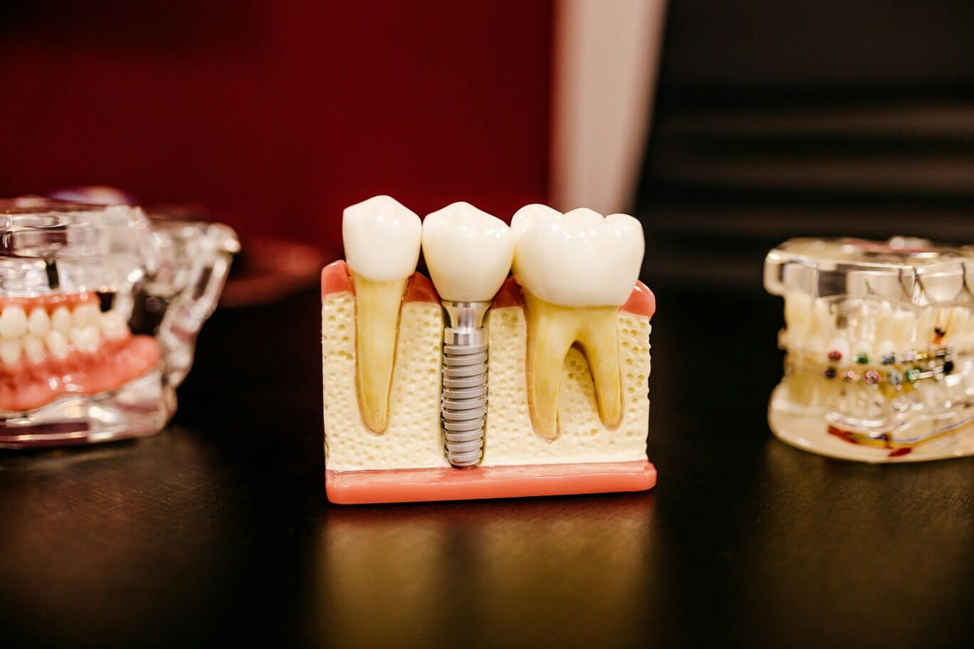 root-canal-treatment